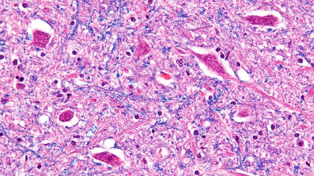 Células creadas en laboratorio para avanzar contra la&nbsp;ELA